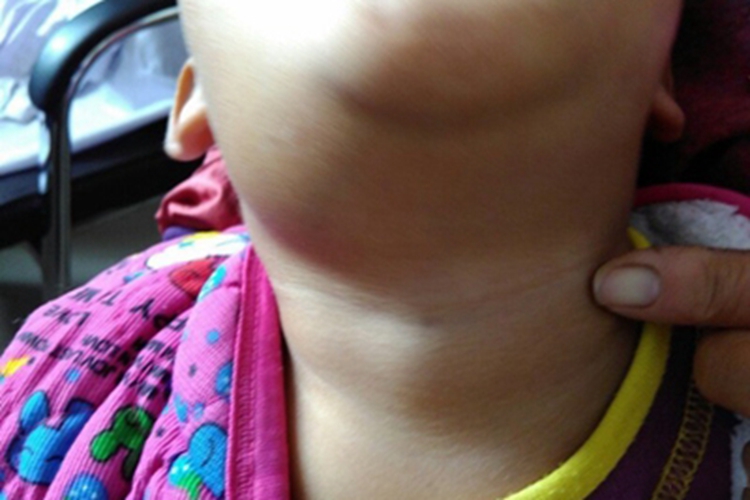 慢性扁桃体炎脖子肿了图