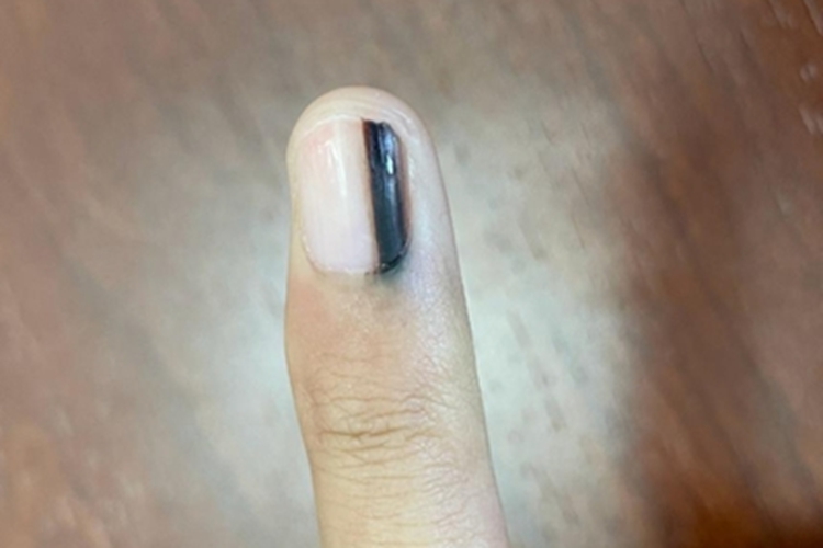 肢端雀斑痣样黑素瘤手指甲症状图