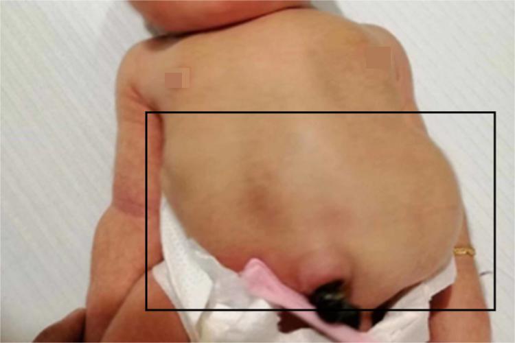 脊椎骨骺发育不良腹部大包图