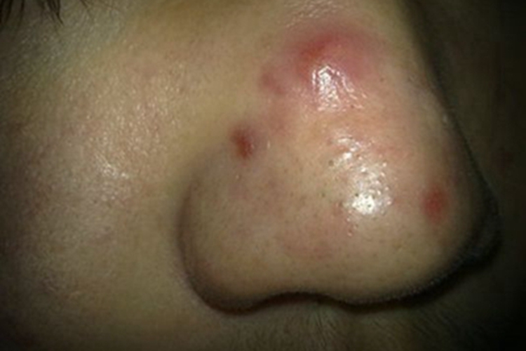 鼻疖鼻部有红色脓包图