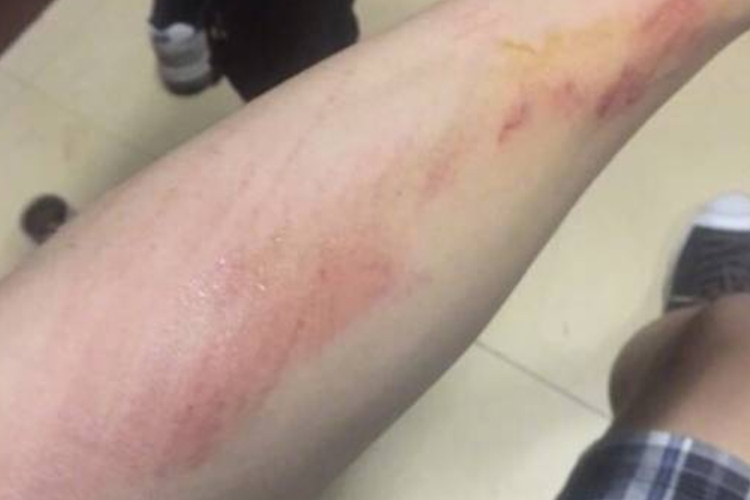 受损没表皮皮肤淡粉色图