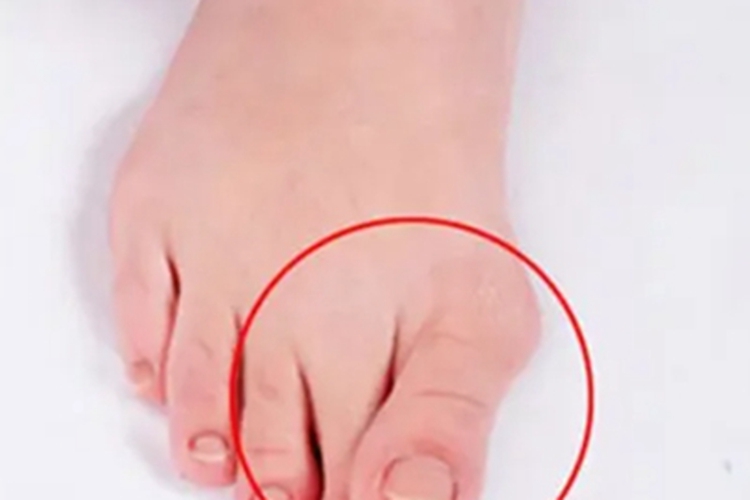 拇囊炎大脚趾畸形图