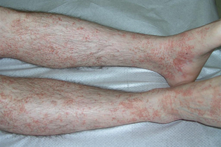 苔藓样念珠状疹小腿有小红疙瘩图