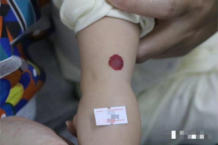 杆菌性血管瘤胳膊紫斑图