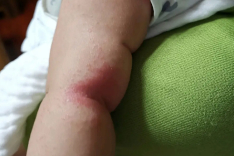 婴儿钱币状湿疹图 婴儿钱币状湿疹图