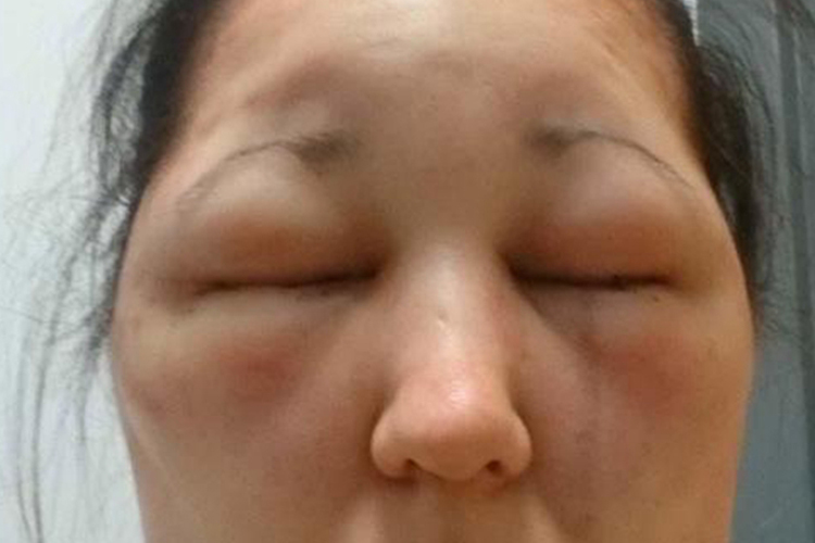 甲状腺脸浮肿图