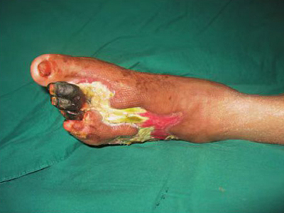 坏死性筋膜炎脚趾有三根完全变黑图.jpg