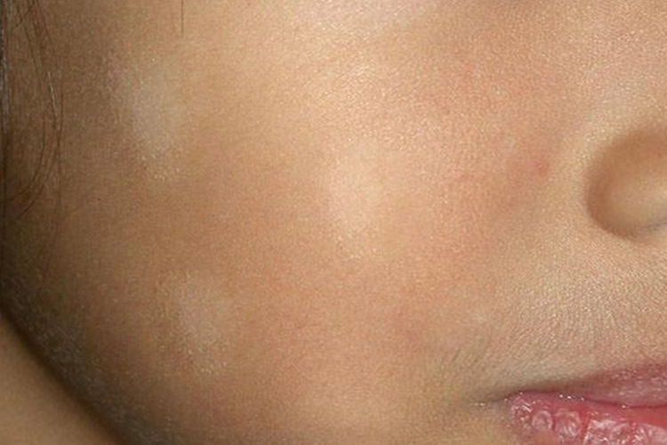 小孩面部白色糠疹图 小孩面部白色糠疹图