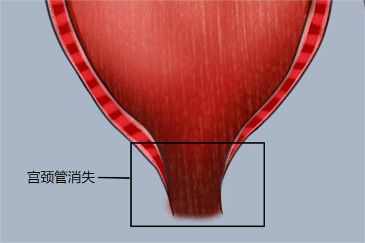 宫颈管消失呈桶状图