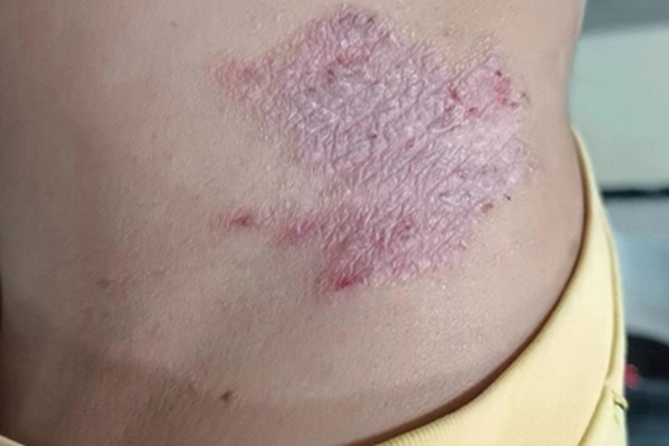 播散性神经性皮炎皮肤粗糙图