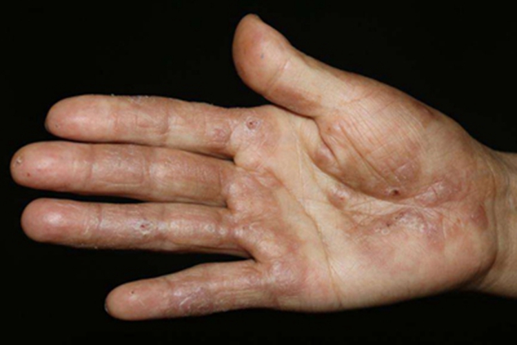 持久性隆起性红斑手掌包块图