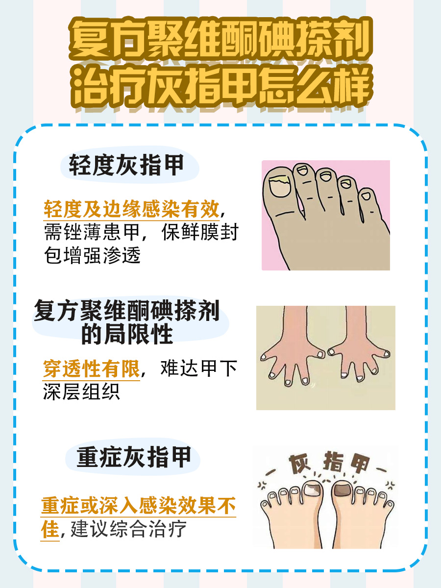 复方聚维酮碘搽剂治疗灰指甲，效果如何？