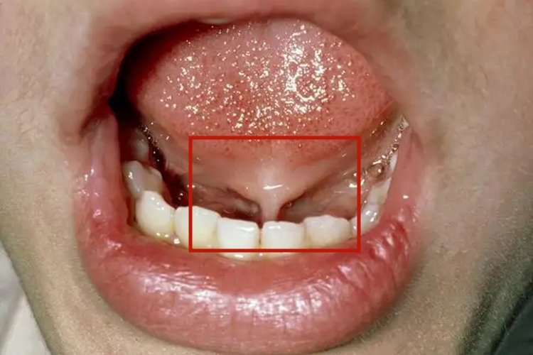 小儿心脾积热重舌图