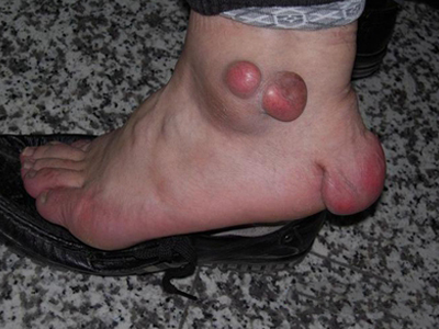 结节性黄瘤脚上大红疙瘩图