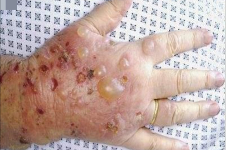 寻常型天疱疮手背水疱图 寻常型天疱疮手背水疱图