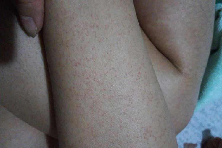 白血病小血点图