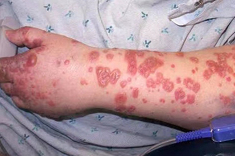 线状lgA大疱性皮病胳膊症状图