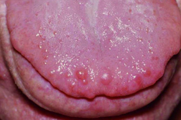 皮肤黏液瘤舌尖症状图 皮肤黏液瘤舌尖症状图