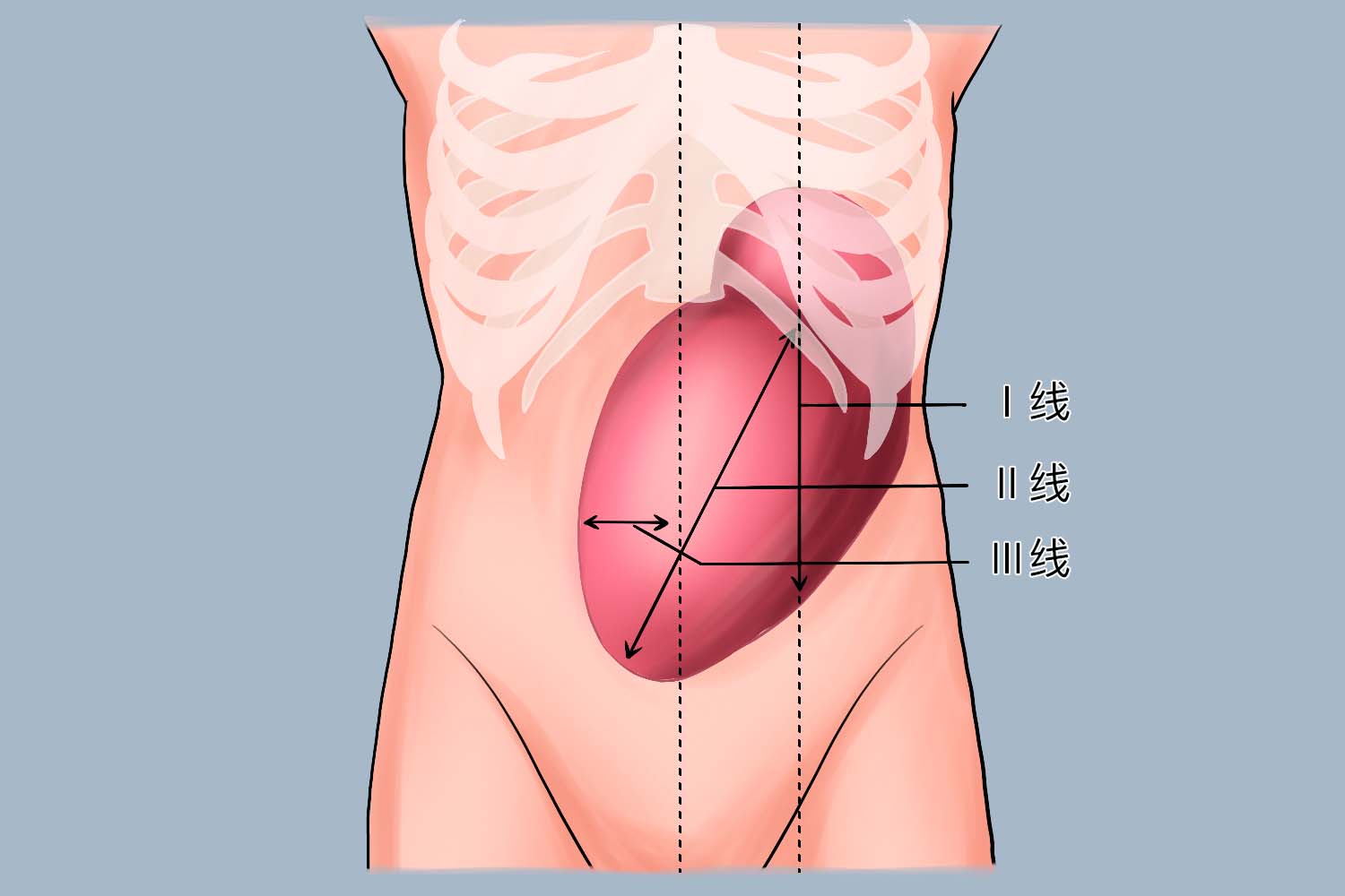 脾脏测量三条线示意图