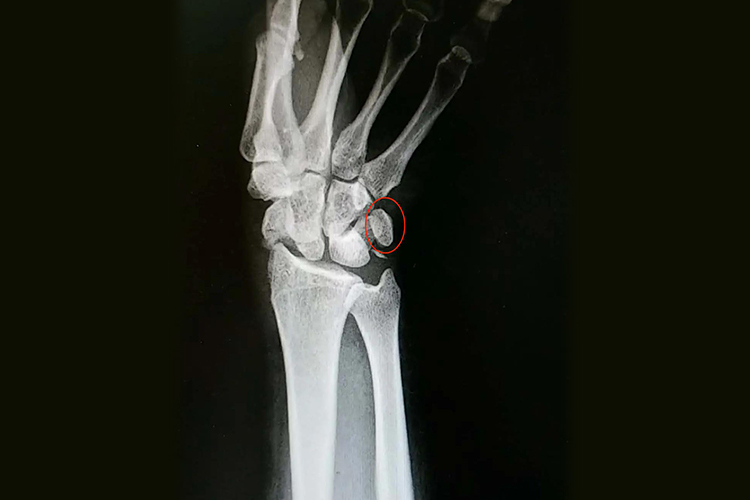 手腕豆状骨影像图