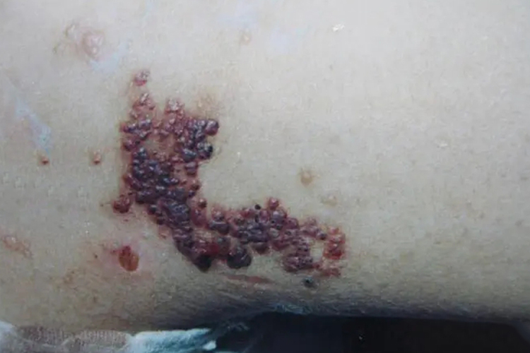 局限性血管角化瘤图