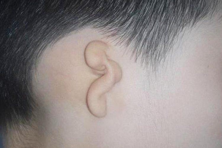 小耳畸形图