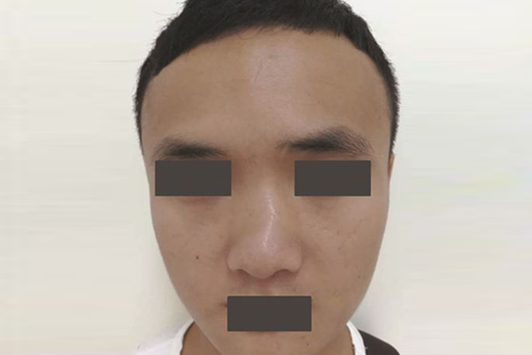 严重型鼻中隔偏曲图