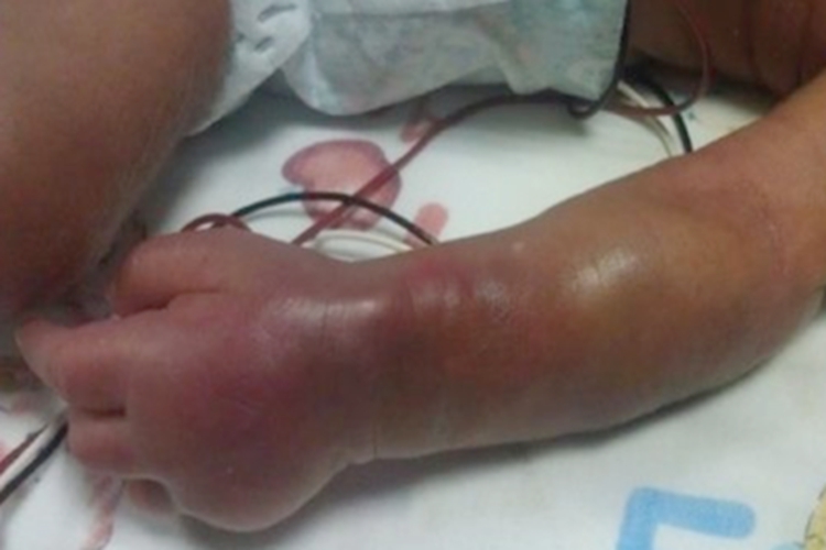 新生儿硬肿症胳膊症状图 新生儿硬肿症胳膊症状图