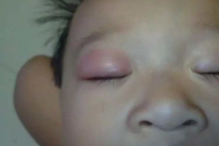 上眼皮蚊虫叮咬图