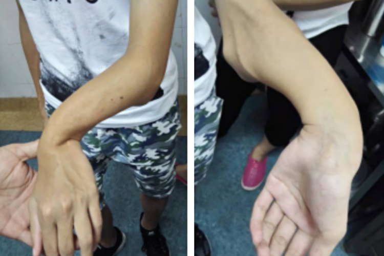 手腕骨折畸形愈合图 手腕骨折畸形愈合图