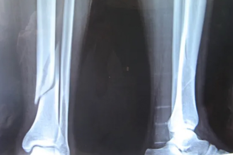 胫骨下1/3段骨折图