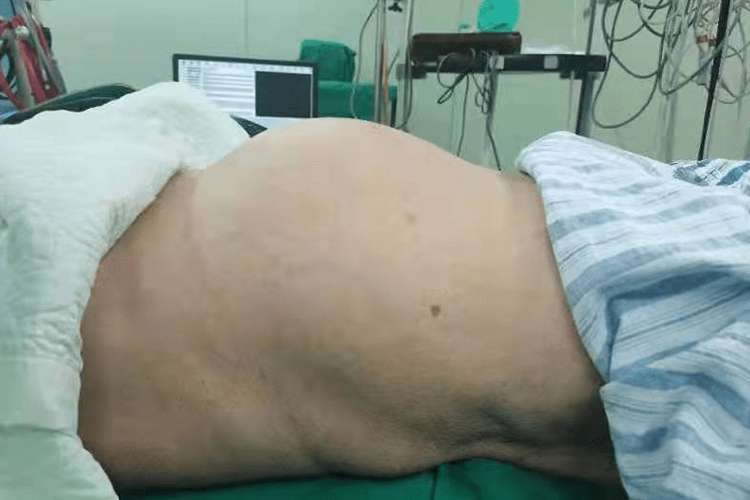 结肠癌晚期肚子鼓图