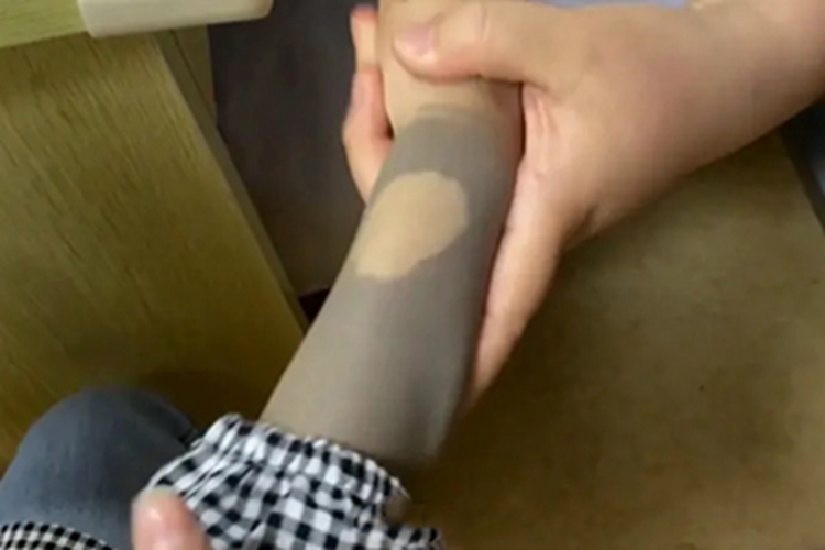 伊藤痣胳膊几乎布满青斑图