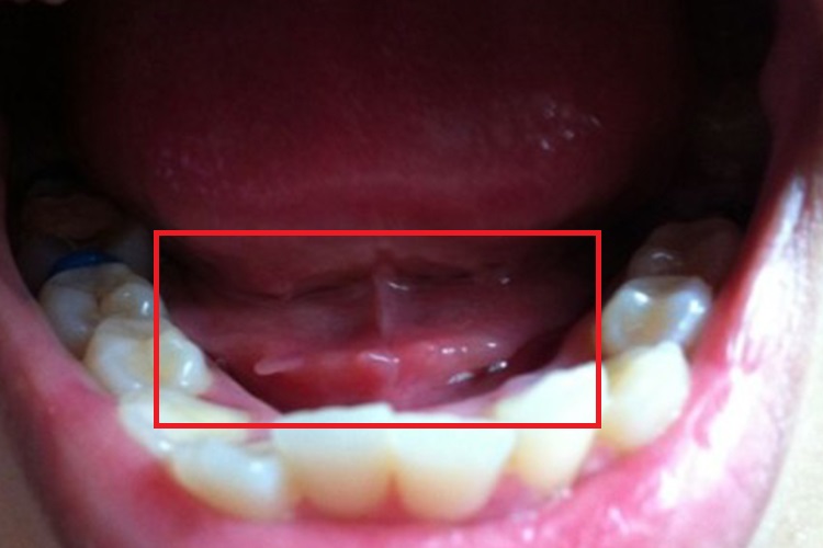 舌下肉芽图 舌下肉芽图