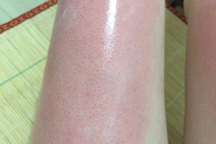 光毒性接触性皮炎腿症状图 光毒性接触性皮炎腿症状图