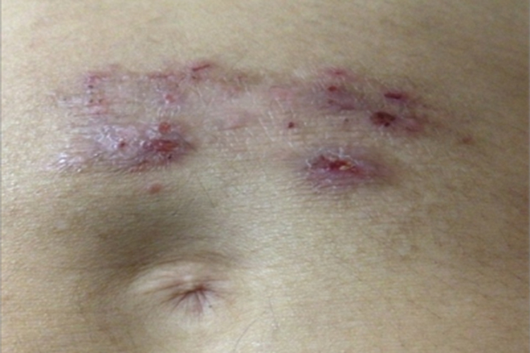 镍皮炎腹部有皮损图