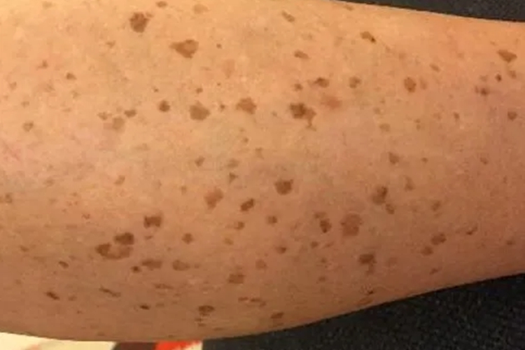 脂溢性角化病小腿长斑图