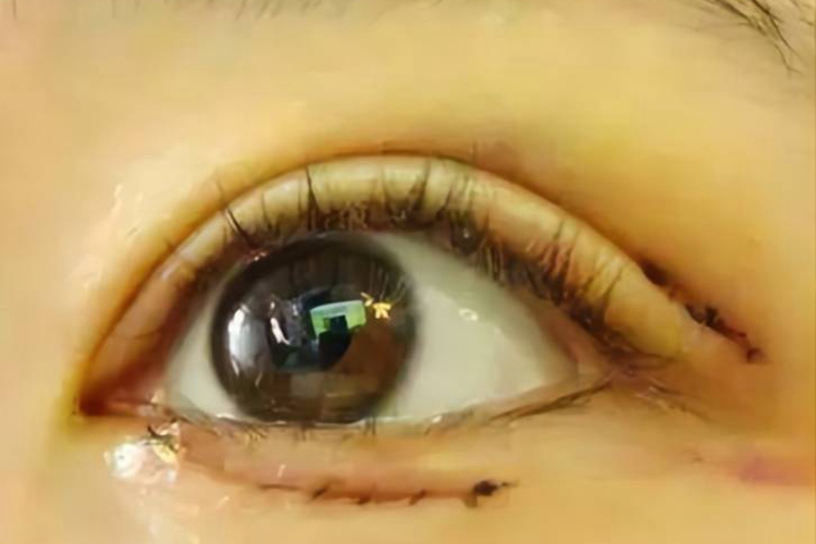 儿童倒睫缝线法手术恢复图