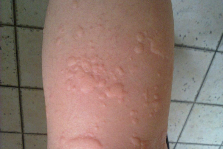 荨麻疹大片扁疙瘩图