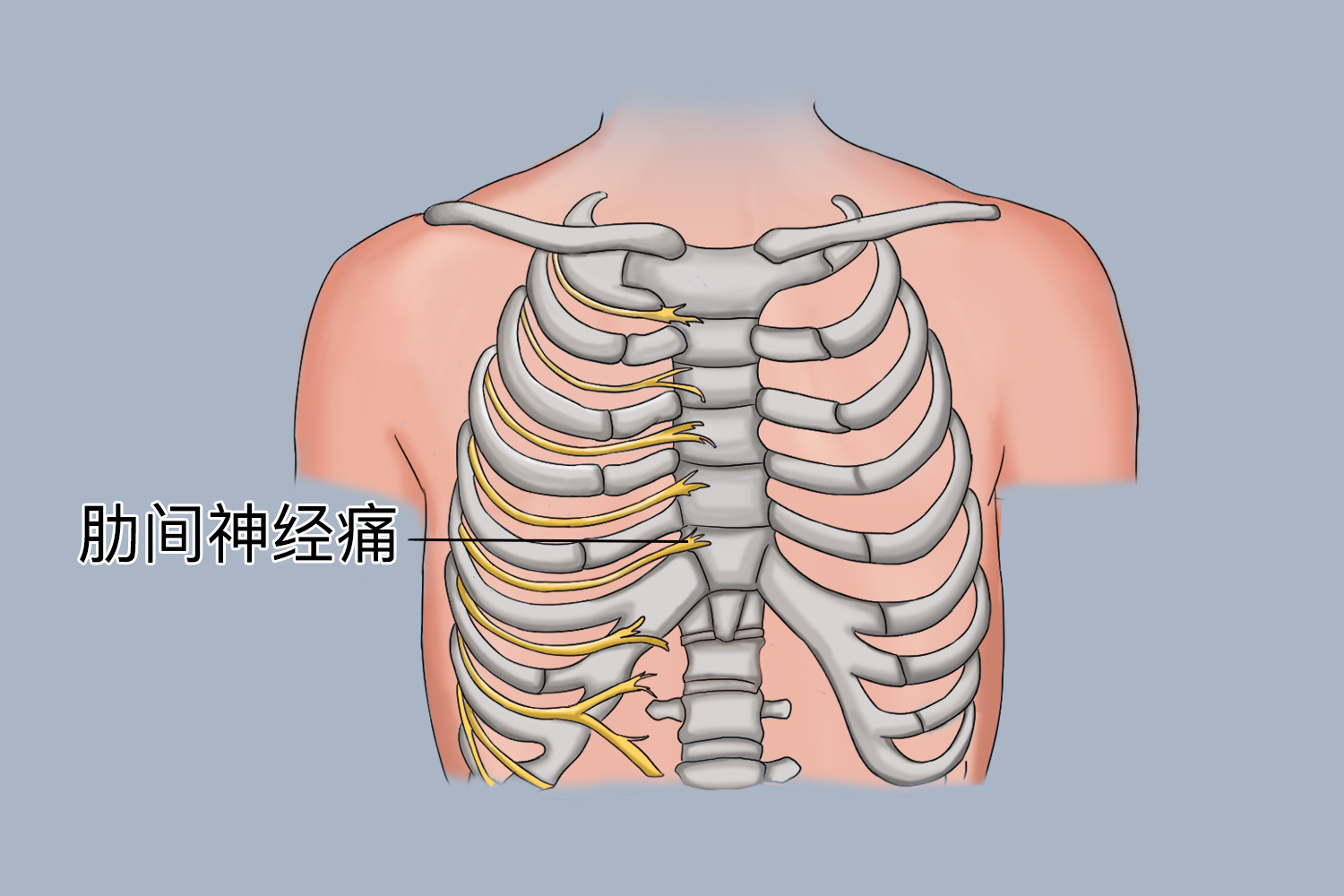 怎样判断是肋间神经炎图片