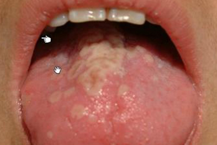 手足口病舌头上起泡图片