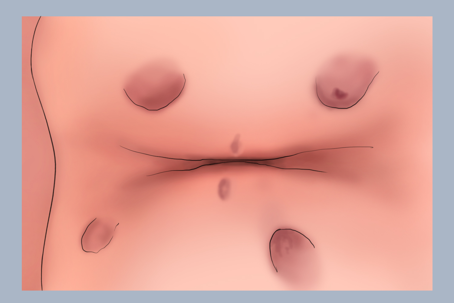 婴儿多位肛瘘图 婴儿多位肛瘘图