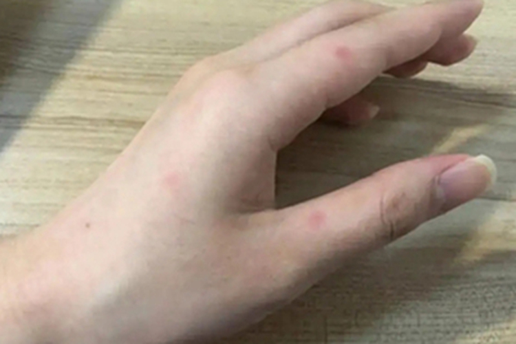 虫咬皮炎手指红斑图