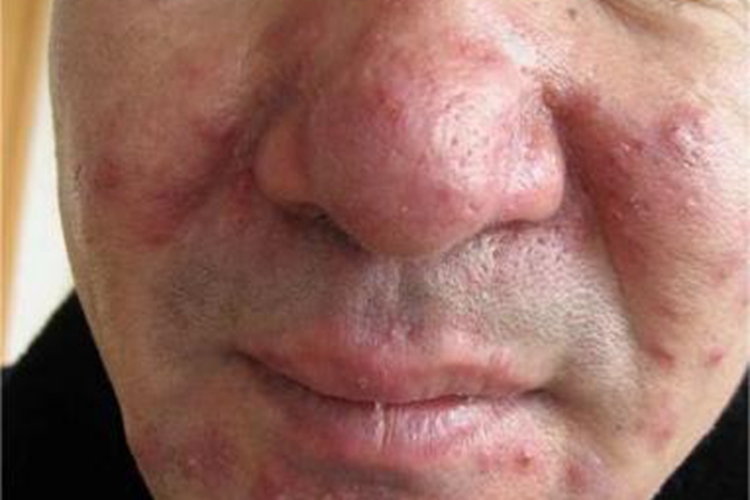 蠕形螨病面部红斑图