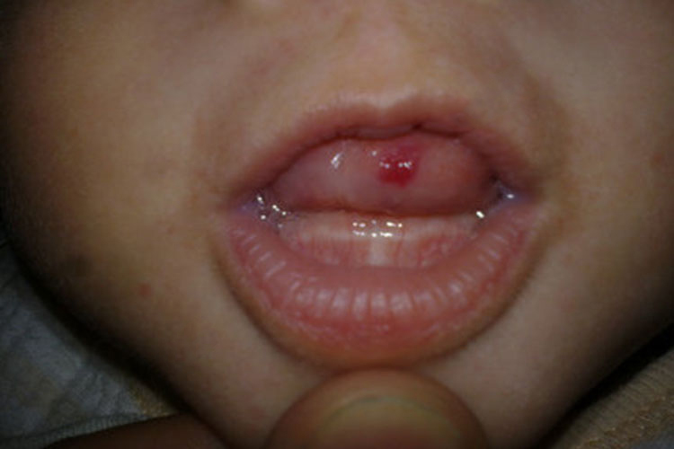 舌下口腔血管瘤图 舌下口腔血管瘤图