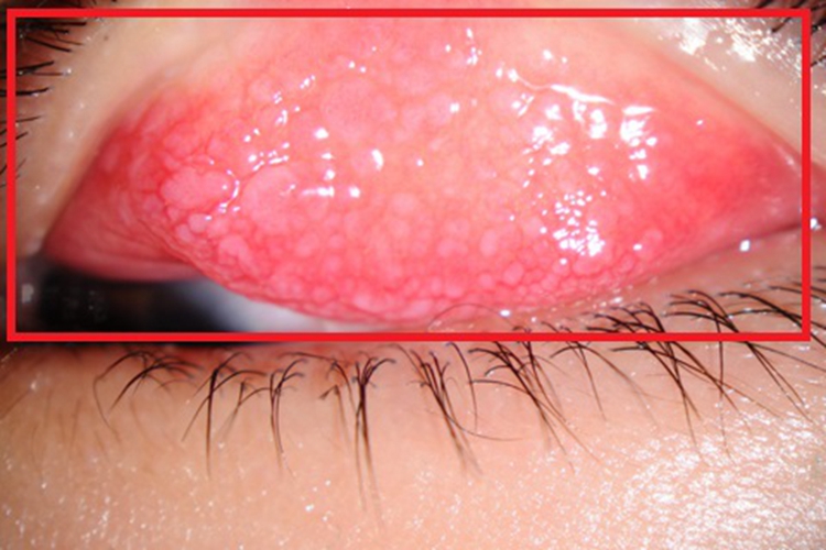 腺病毒性角结膜炎结膜症状图 腺病毒性角结膜炎结膜症状图