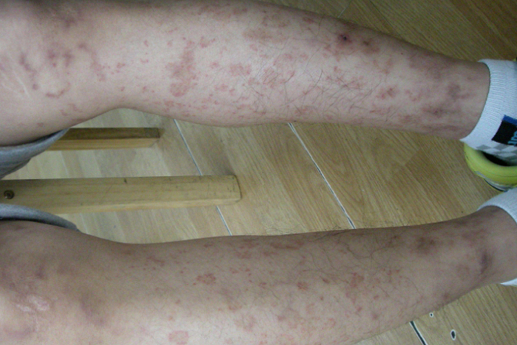 腿部毛细血管环状紫癜图