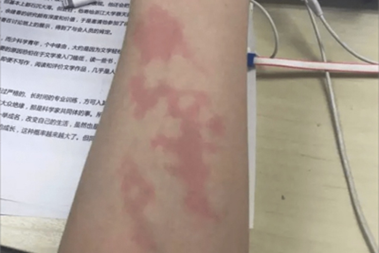 热激红斑症状图