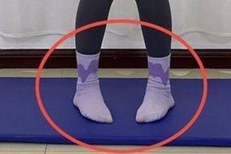 X型腿足尖内偏图