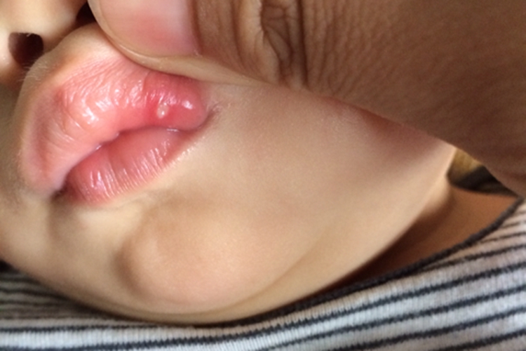 9个月婴儿口腔溃疡图